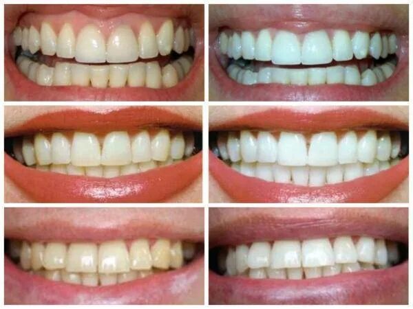 После чистки зубов можно ли пить чай. Результат отбеливания. Отбеливание зубов до и после. Отбеливание зубов содой. Зубы до и после отбеливания.