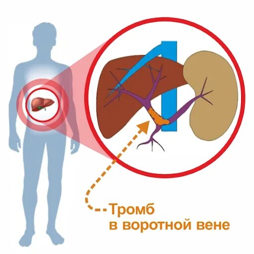 Тромб в печени