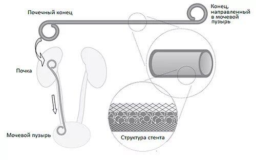 Стент мочеточника отзывы. Стентирование мочевого пузыря. Урологический стент. Стент из почки в мочеточник.