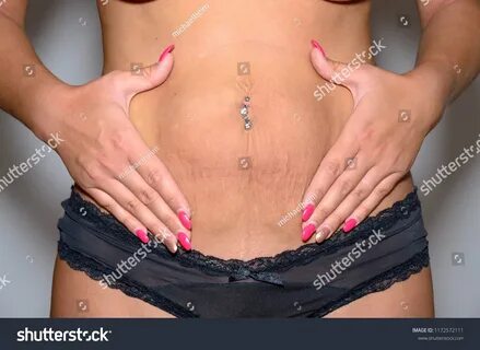 Old belly button piercing -weird! will Stretch Marks High Resolution Stock stretche...