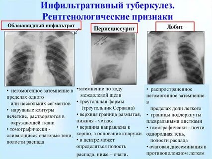 Для очагового туберкулеза характерно