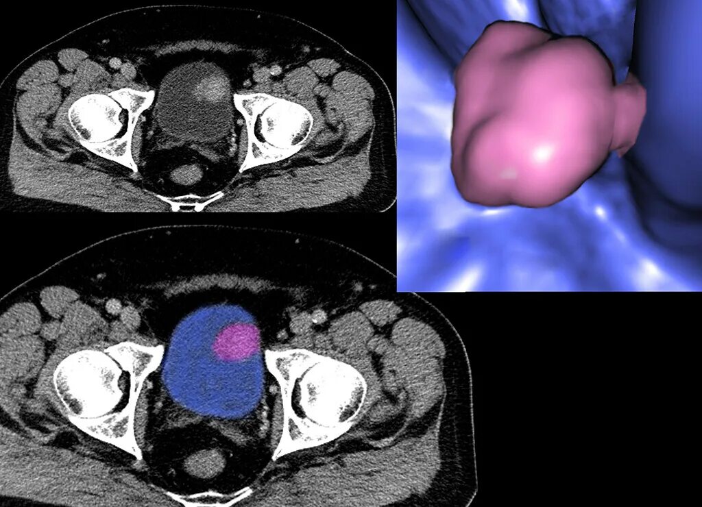 Больной мочевой. Опухоль мочевого пузыря на кт. Компьютерная томография при опухоли мочевого пузыря. Метастазы в мочевой пузырь на кт. Злокачественное новообразование мочевого пузыря.