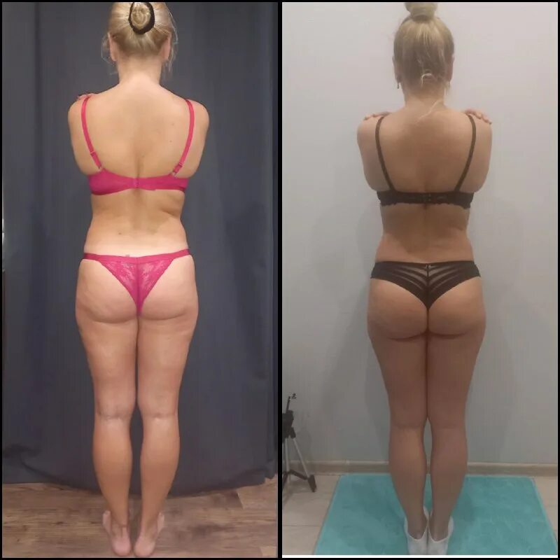 Накачала ягодицы до и после. Уменьшение бедер. Лазерная липосакция галифе. Целлюлит до и после. Уменьшение бедер.