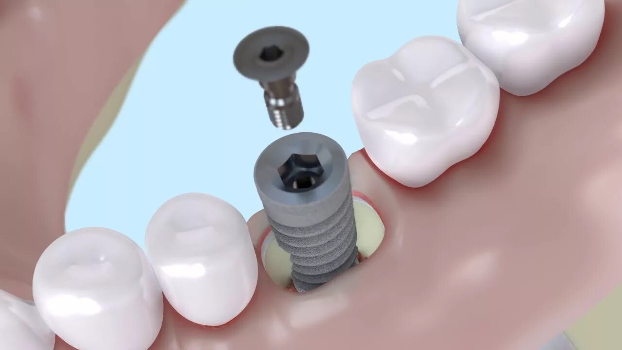 Заглушка на имплант. Заглушка на имплант. Astra винт-заглушка стоматология. Формирователь и абатмег. Заглушка на имплант.