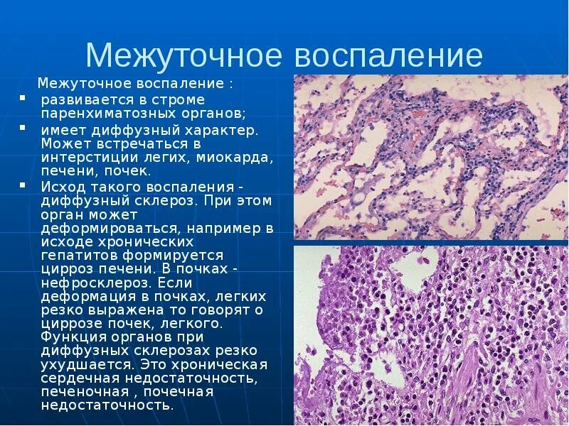 Очаг продуктивного воспаления гистология. Интерстициальное воспаление патанатомия. Хроническое воспаление патологическая анатомия. Продуктивное воспаление микропрепарат. Диффузная реакция