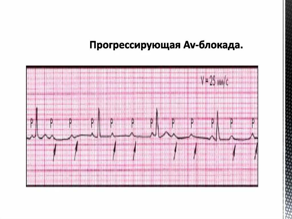 Блокада со стороны блокада. Неполная АВ блокада 2 степени 2. АВ блокада 4 степени на ЭКГ. АВ блокада 3 степени на ЭКГ. Прогрессирующая са блокада 2 ст.