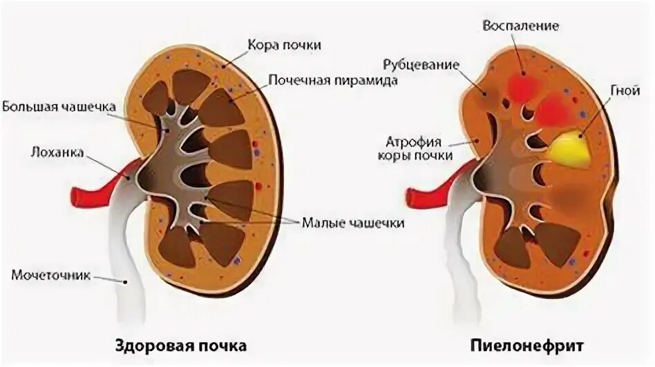 Бактериальное воспаление почек. Воспалилась почка что делать. Симптомы поражения почек. Симптомы болезни почек. Воспалилась почка что делать.