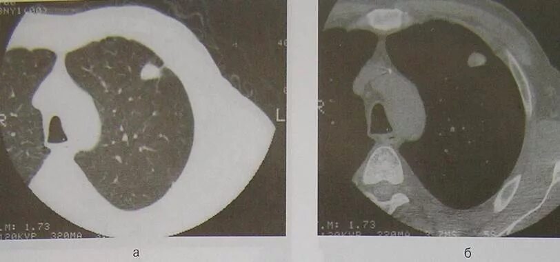 Туберкулома легкого на кт. Туберкулома легкого на кт. Туберкулема лёгкого кт. Рентген туберкулез туберкулема. Туберкулема на кт легких.