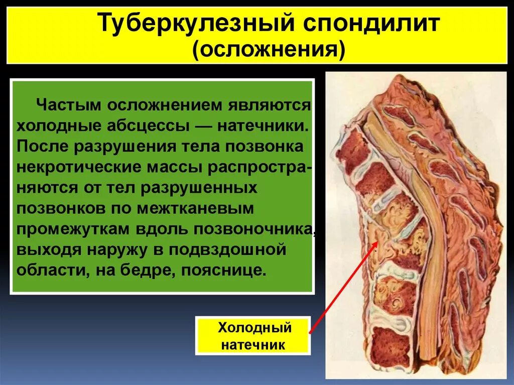 Натечный абсцесс. Tuberkulyyoz spondilit. холодные натечные абсцессы.