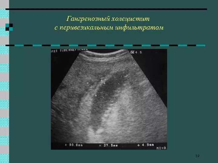 Острый калькулезный холецистит узи. Острый гангренозный калькулезный. Калькулезный холецистит макропрепарат. Жкб, флегмонозный калькулезный холецистит. Острый калькулезный холецистит.
