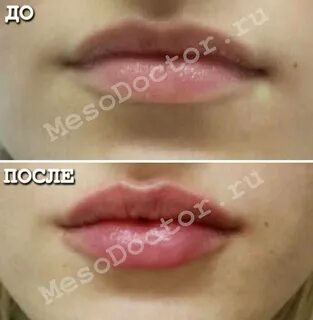 Какой филлер лучше для увеличения губ