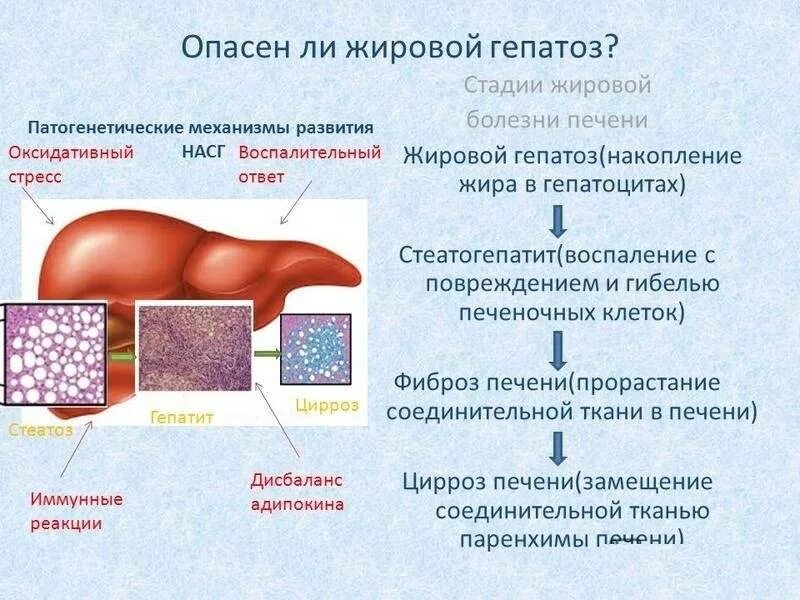 Как избавиться от жирового гепатоза печени
