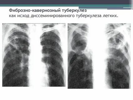 Туберкулезные изменения в легких
