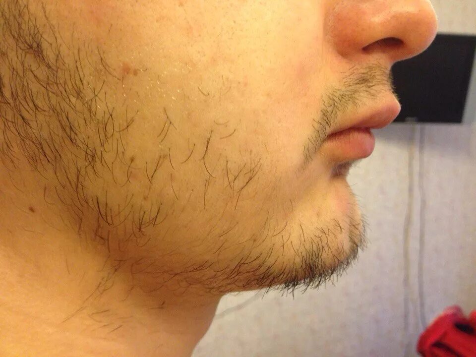 Борода растет. Волосы на подбородке у мужчин. Неравномерная щетина. Брить пушок