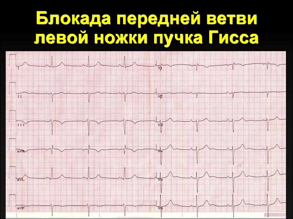 Блокада передне лнпг. Неполная блокада передней ветви ЛНПГ на ЭКГ. Блокада передней ветви ЛНПГ на ЭКГ. ЭКГ при блокаде передней ветви левой ножки пучка Гиса. ЭКГ при блокаде ветвей левой ножки пучка Гиса.