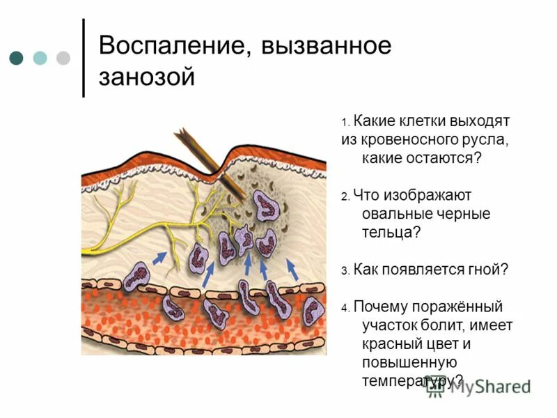 схема воспалительного процесса. схема воспалительного процесса. нейровоспалительный процесс. воспалительный процесс биология 8 класс. воспаление это типовой патологический процесс.