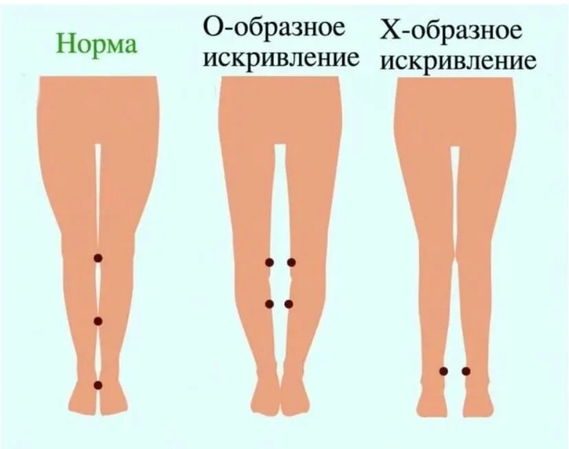 Почему ноги колесом. Варусная деформация стопы у ребенка 10 лет упражнения. Варусная деформация конечностей. Х образное искривление ног.