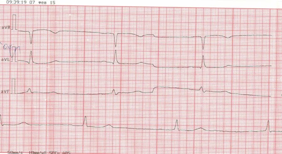 блокада мобитц 2. мобитц 2 на экг. Av блокада 2 мобитц 2. ав-блокады ii степени ii типа (мобитц ii),. ав блокада 2 степени мобитц 1 на экг.