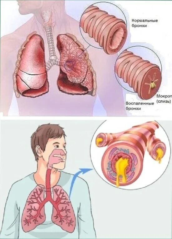 У мужчины мокрота. Вывод мокроты из лёгких. Бронхи с мокройто.