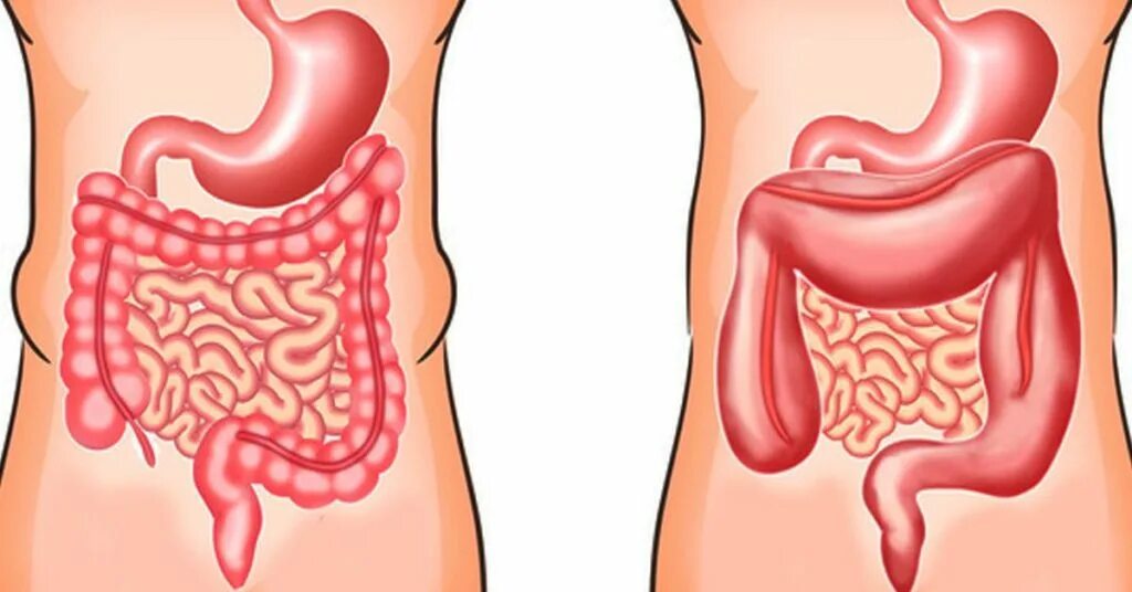 Метеоризм жкт. Метеоризм жкт. Метеоризм жкт. Вздутие живота желудка. Тяжесть в животе.