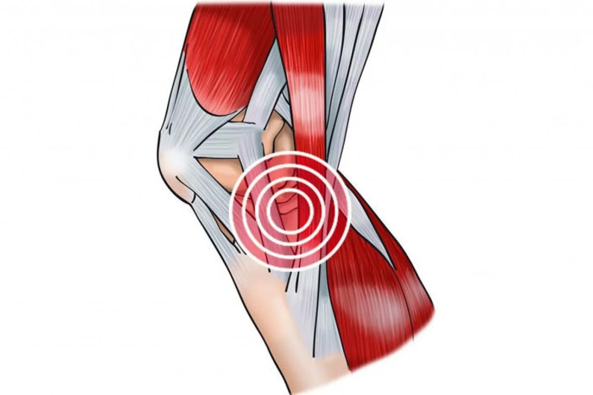 Боль коленной связки. Тендинит сухожилия подколенной мышцы. Тинезит коленного сустава. Тандерид коленного сустава. Тендинопатия сухожилия подколенной мышцы.