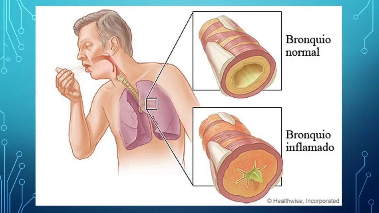 Чем лечить острый бронхит. Влияние курения на органы дыхания. Влияние курения на бронхи.