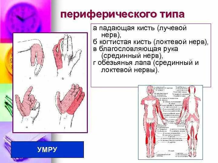 Поражение нервов руки. Синдром поражения лучевого нерва. Положения кисти при повреждении нервов. Поражение срединного нерва симптомы. Когтистая лапа при поражении локтевого нерва.