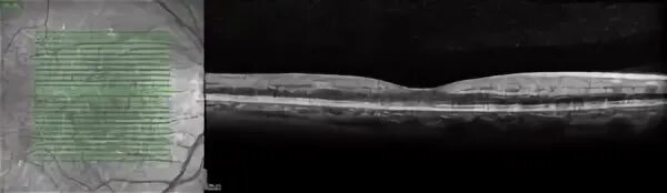 Oct image
