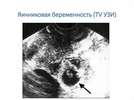 Внематочная беременность на узи