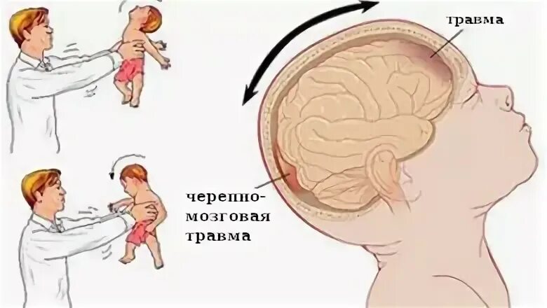 Тряска младенцев. Симптом тряски ребенка. Симптомы встряхнутого ребенка. Синдром встряхивания ребенка.