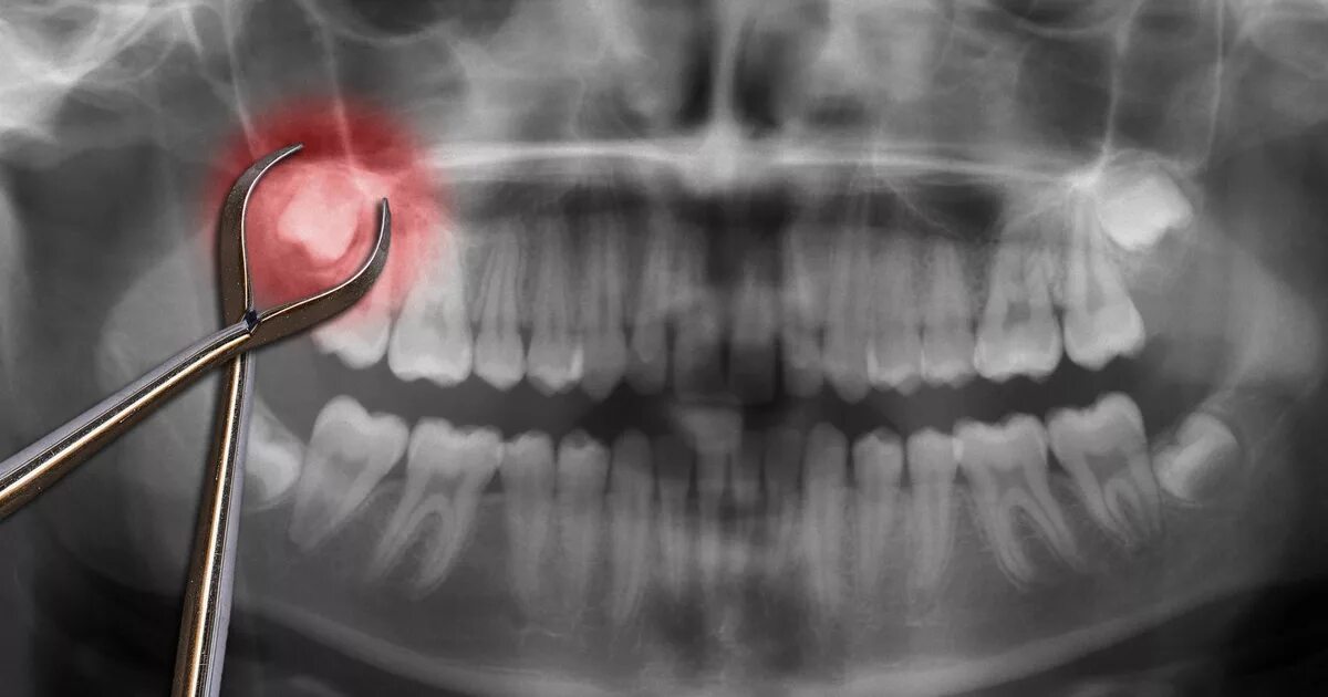 Ретинированный дистопированный зуб. Дистопированный зуб мудрости. Зуб 8 корень