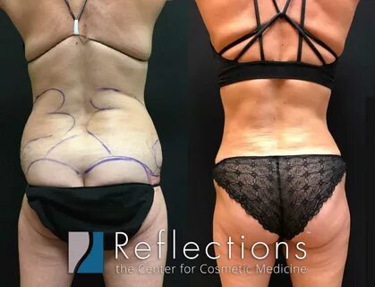 Best Vaser Liposuction Specials Near Me NJ Vaser Lipo Price Cost