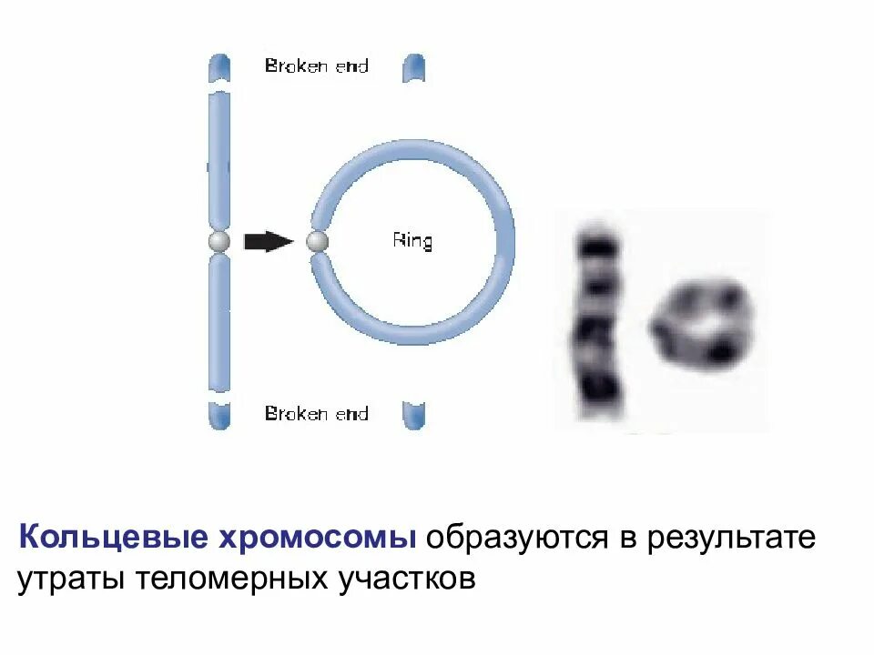 Имеется кольцевая хромосома. Кольцевая хромосома. Возникновение кольцевых хромосом. Образование кольцевой хромосомы. Механизм образования кольцевой хромосомы.