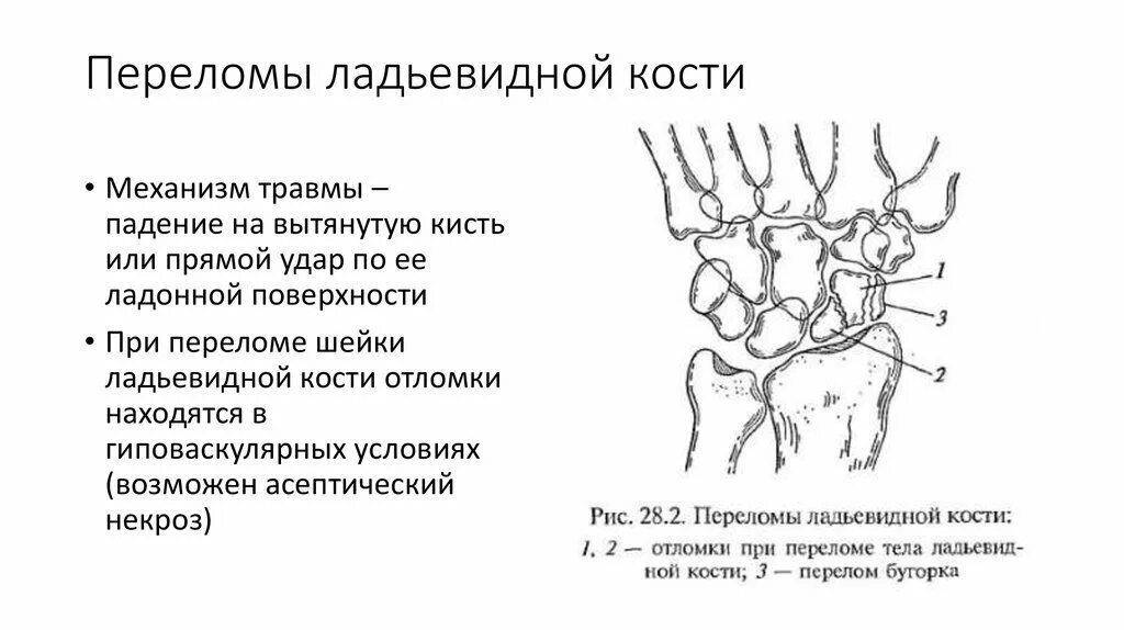 Перелом лучезапястного сустава лечение. Перелом бугорка ладьевидной кости кисти. перелом бугорка ладьевидной кости. переломы костей запястья классификация. ладьевидная кость запястья переломы классификация.