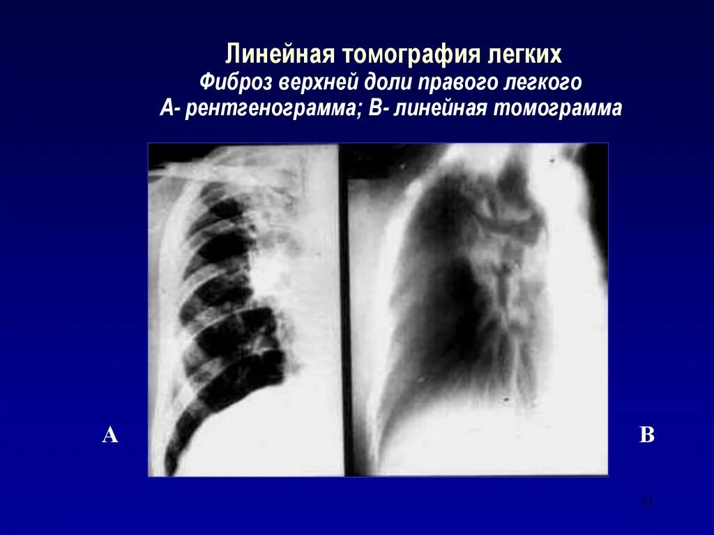 Фиброз в доле легкого. Легочный фиброз на рентгене. Пневмофиброз томограмма. Рентгенография линейная томография. Линейная томограмма легких туберкулез.