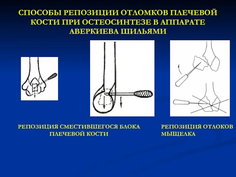 Репозиция отломков при переломе. Способы репозиции костных отломков. методы репозиции отломков. методы сопоставления костных отломков.