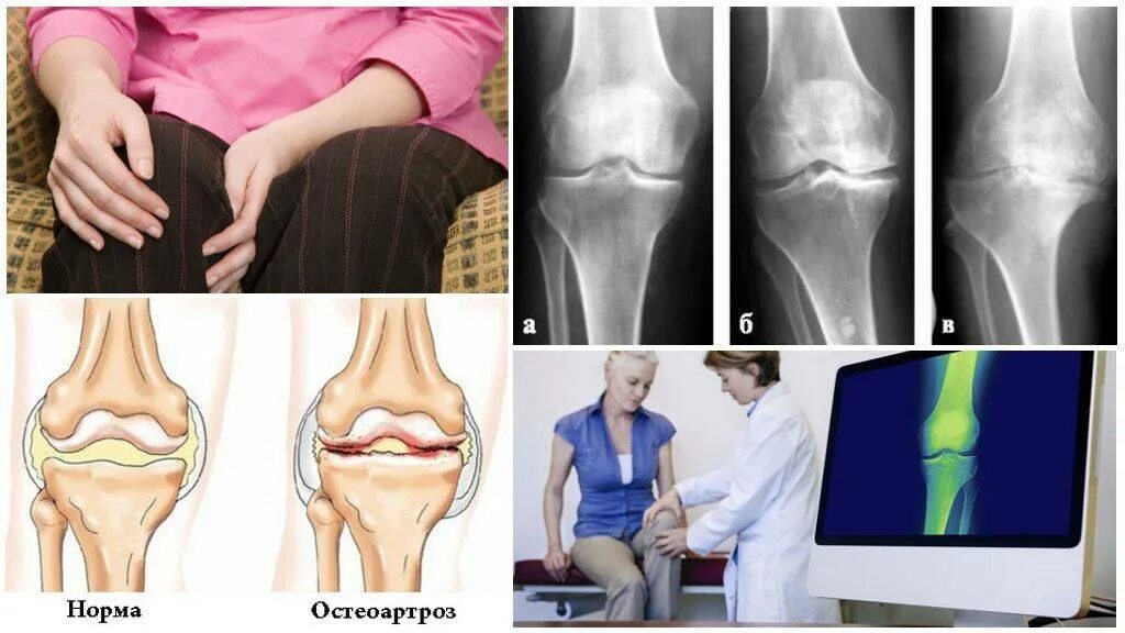 Остеоартроз 1 2 степени коленного сустава. Деформирующий остеоартроз коленного сустава (гонартроз). Артроз (деформирующий артроз, остеоартроз). Деформирующий остеоартроз (доа). Деформирующий остеоартроз коксартроз гонартроз.