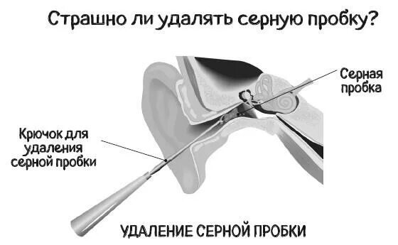 Как избавиться от серной пробки. Крючок для серной пробки. крючок для удаления серных. методики удаления серных пробок. удаление серной пробки из уха крючком.