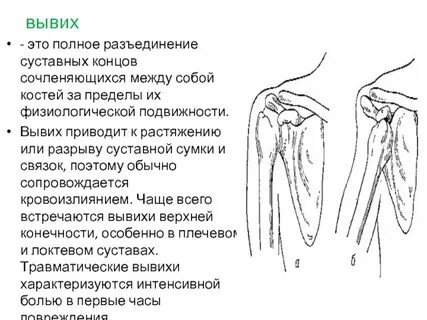 Полный вывих