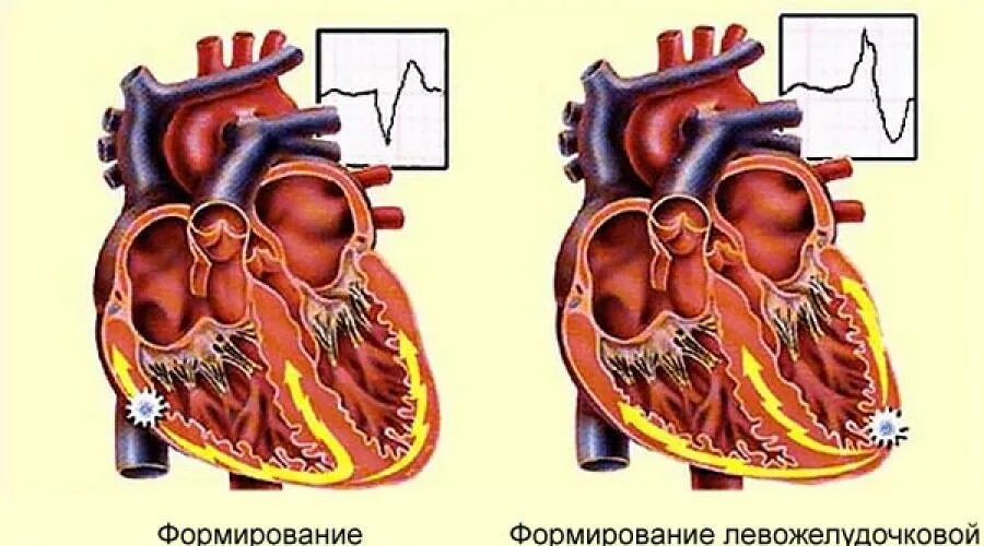 Недостаточность предсердия. ХСН правожелудочковая недостаточность. Правожелудочковая и левожелудочковая сердечная недостаточность. Левожелудочковая и правожелудочковая недостаточность. Острой левожелудочковой недостаточности.