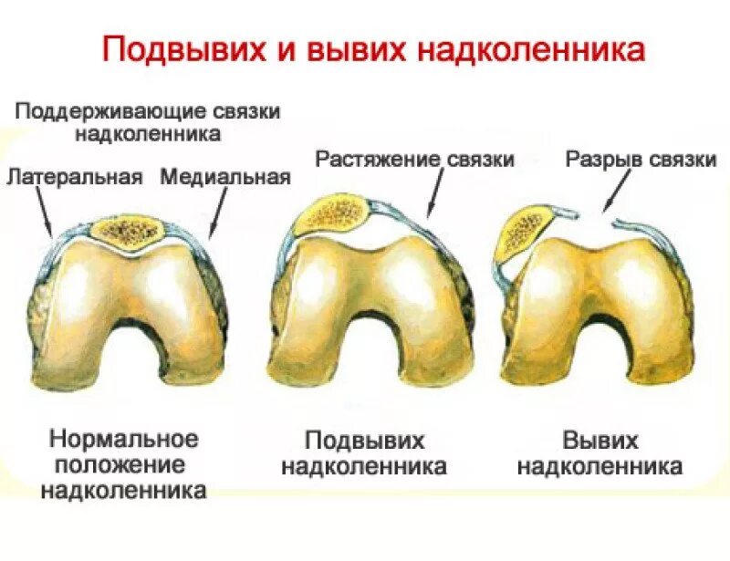 Латерализация надколенника. Врожденный вывих надколенника рентген. Привычный подвывих надколенника операция. Врожденный вывих надколенника мрт. Травматический вывих надколенника.