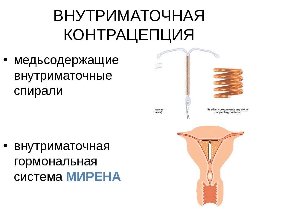 Вмс ф. Внутриматочные противозачаточные спирали. внутриматочная спираль методы контрацептивов. медьсодержащая внутриматочная спираль. контрацепция: внутриматочная спираль (вмс).