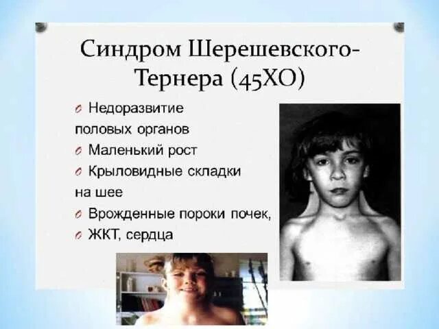 Синдром шерешевского тернера частота. Кариотип шерешевского. Синдром шерешевского тернера. Cbylhjv ithtdthcrjuj tnhythf. Хромосомные болезни синдром шерешевского-тернера.