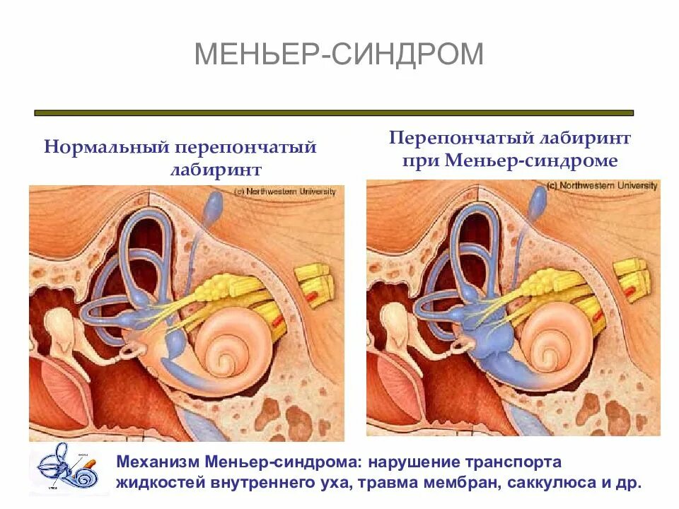 Синдром миньера что это. Болезнь Меньера гидропс. Барабанная перепонка при болезни Меньера. Снижения слуха при болезни Меньера.