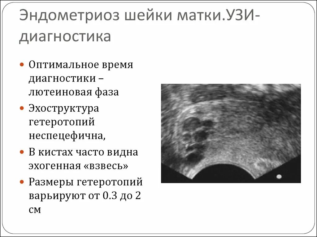 Эндометриоз яичников на УЗИ. Очаговый эндометриоз миометрия. Эндометриоидный очаг шейки матки. УЗИ картина эндометриоза матки.