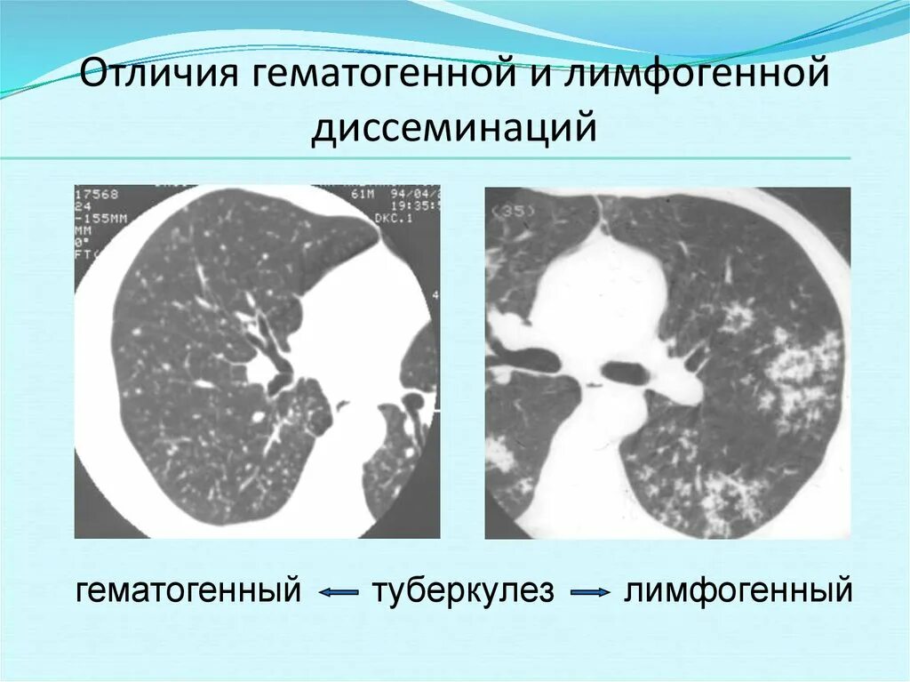 Диссиминация