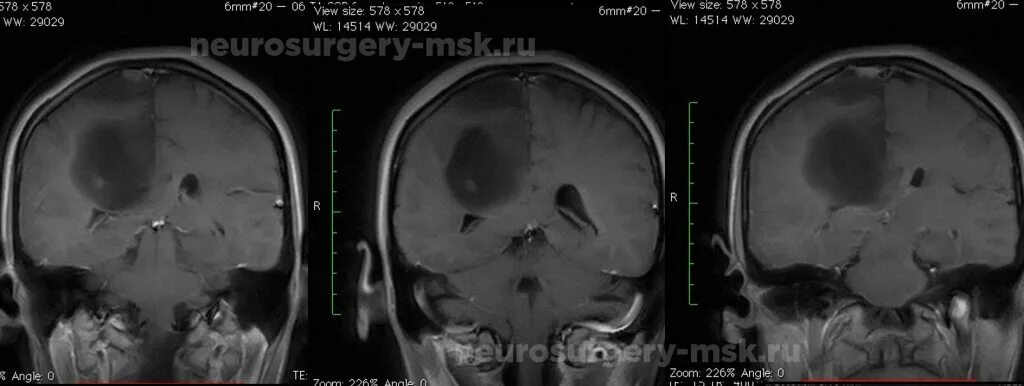 Опухоли лобной части. Внутримозговая опухоль левой лобной доли. Внутримозговая опухоль правой височной доли. Опухоль головного мозга в лобной части.
