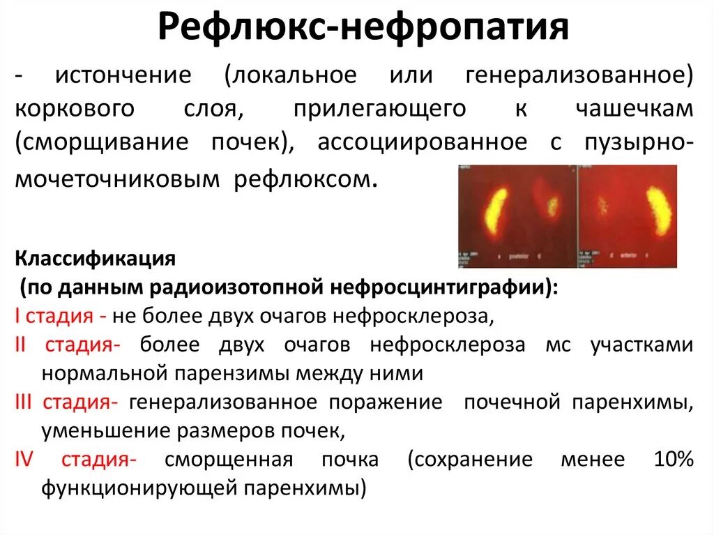 Рефлюкс отзывы вылечила. Патогенез рефлюкс нефропатии. Рефлюкс нефропатия классификация. Рефлюкс-нефропатия у детей классификация. Рефлюкс-нефропатия у детей клинические рекомендации.