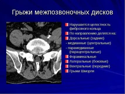 Медиальная грыжа