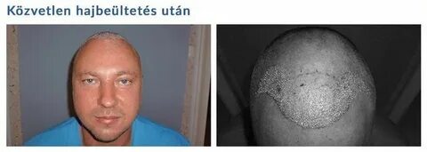 Отек волоса